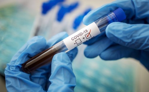 За сутки выявлены 67 новых случаев заражения коронавирусом